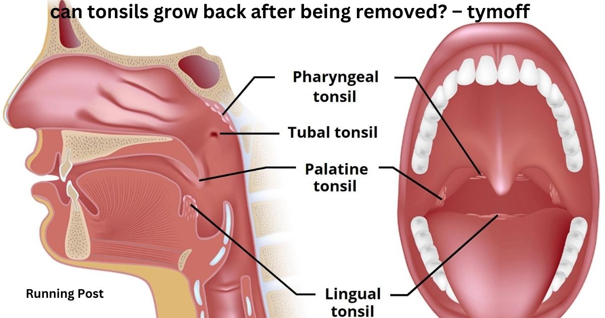 can tonsils grow back after being removed? – tymoff